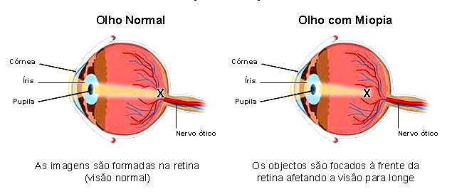 miopia hipermetropia astigmatismo e presbiopia